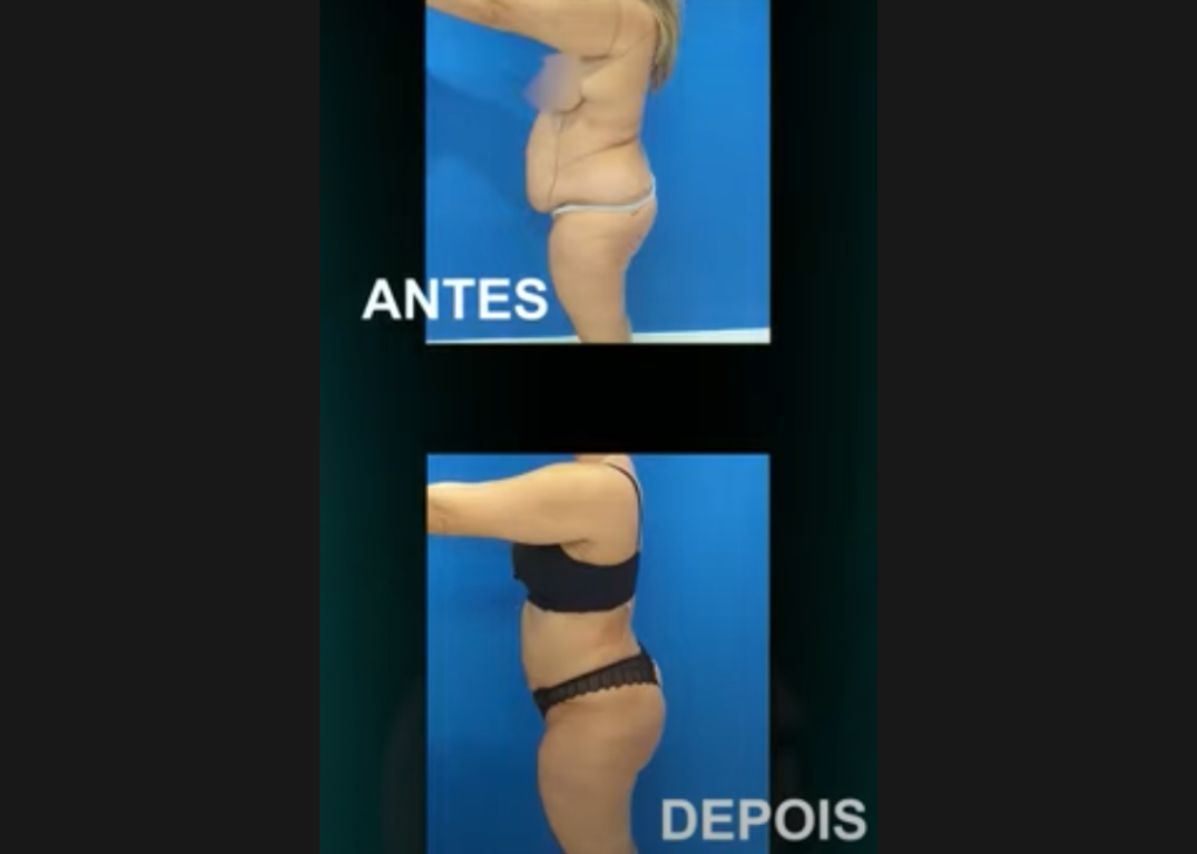 antes e depois vibrolipoaspiracao lipari